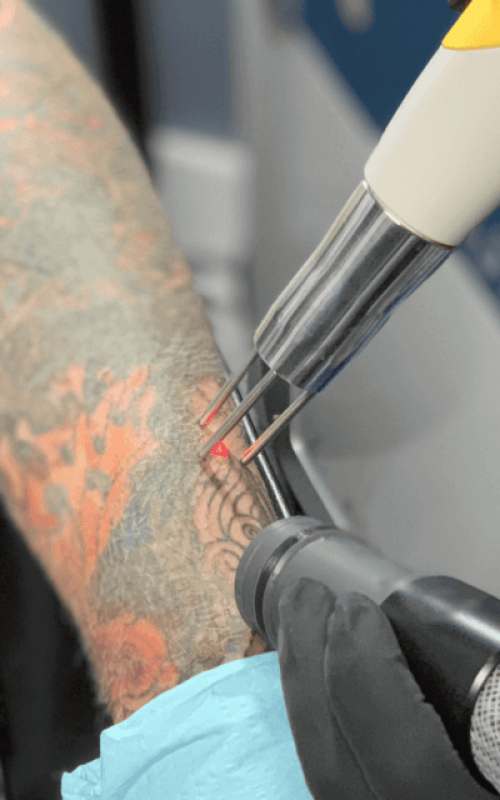 lase-tattoo-removal-1024x640-1